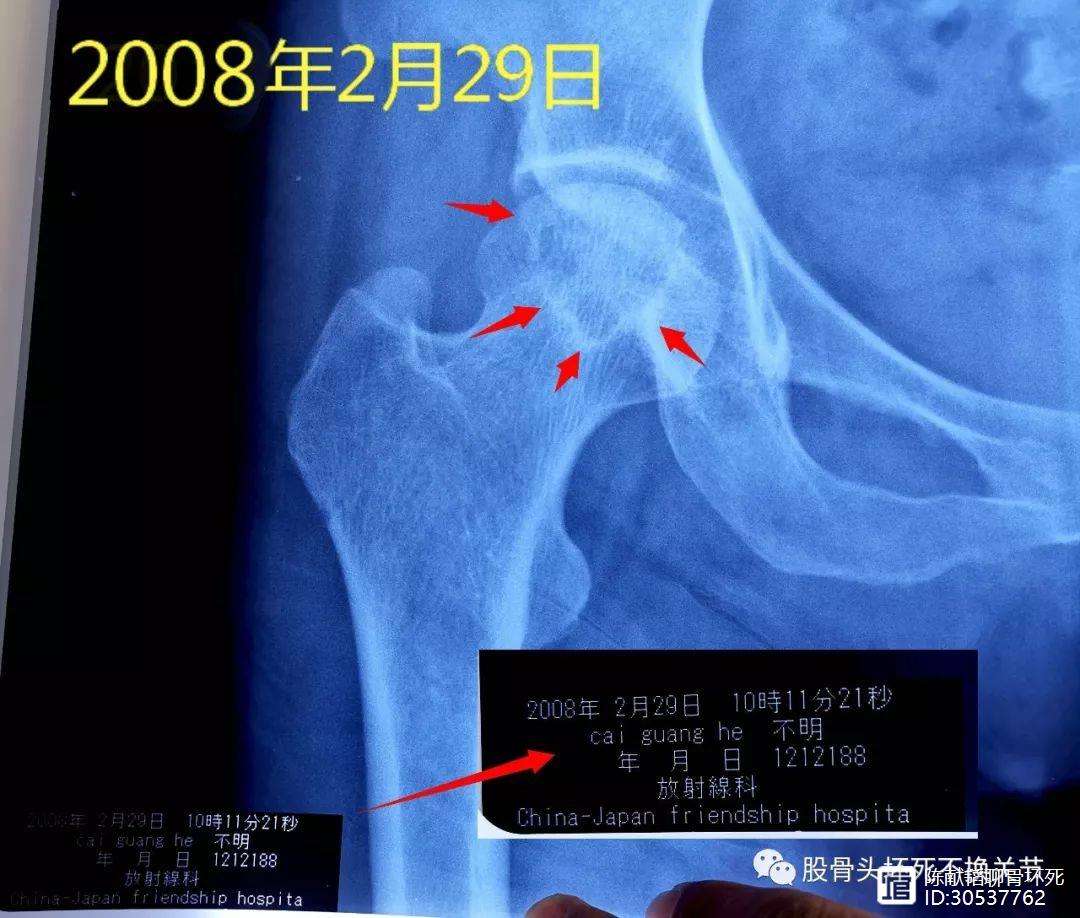 常德人工骨头医保报销多少(人工骨头医保报销多少比例)