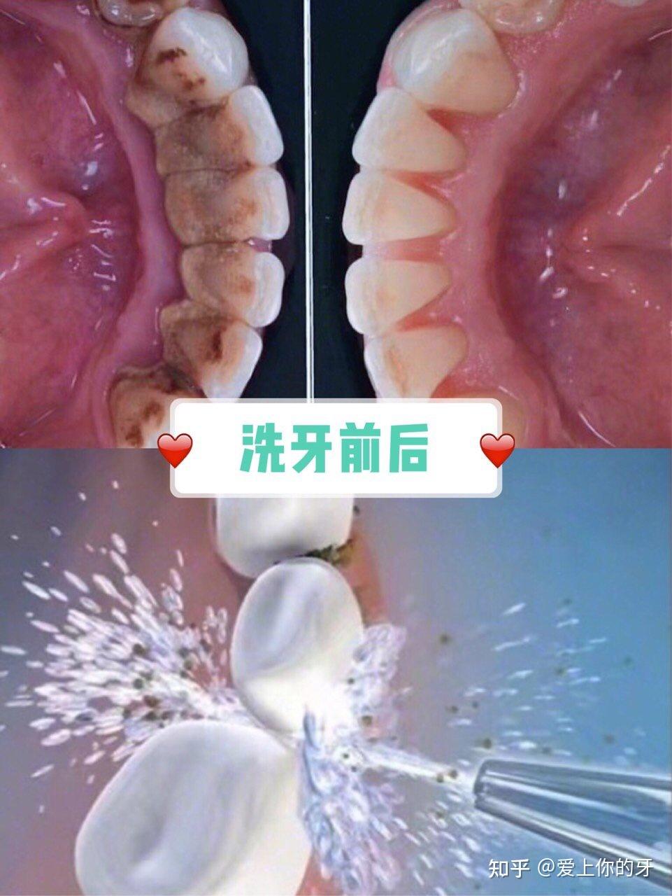 洗牙可以用医保吗(洗牙可以用医保吗,报销比例多少)